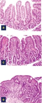 Celiac-Disease-Damage