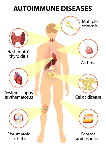 autoimmune diseases